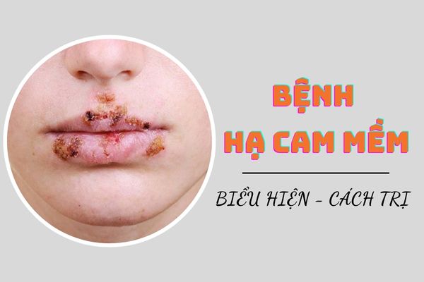 Bệnh hạ cam mềm là gì? Nguyên nhân và hướng điều trị hiệu quả