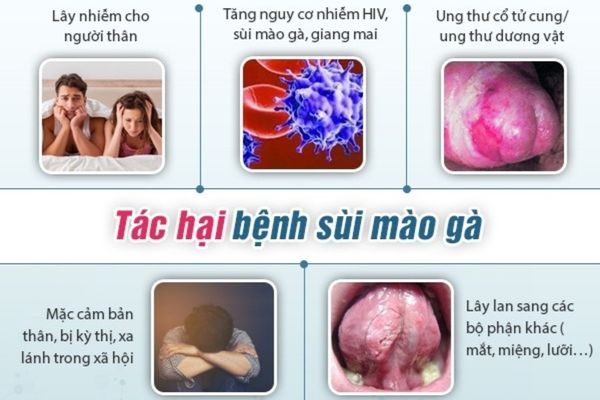 Sùi mào gà gây nhiều ảnh hưởng nghiêm trọng đến sức khỏe