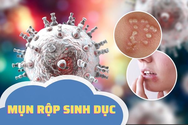 Mụn rộp sinh dục – Bệnh xã hội nguy hiểm với cả nam và nữ giới