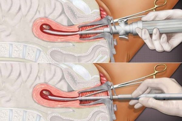 Xuất tinh chậm – Bệnh lý nam giới không nên xem thường