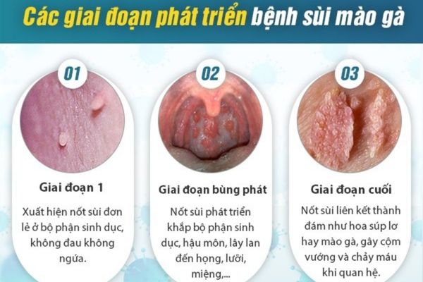 Sùi mào gà có những biểu hiện nhận biết tùy vào từng giai đoạn khác nhau