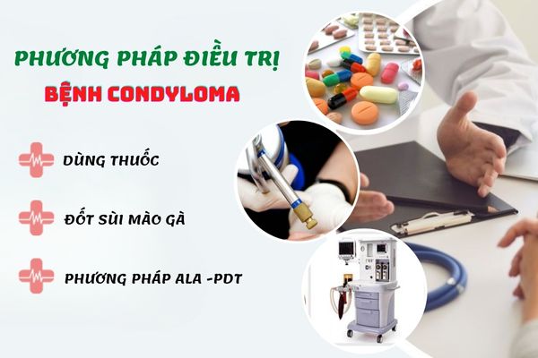 phuong-phap-dieu-tri-benh-condyloma