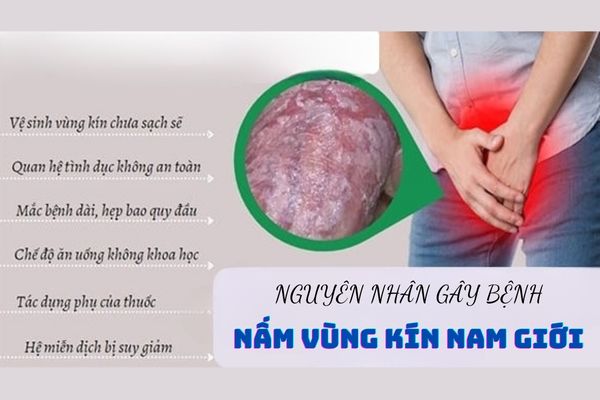 Nguyên nhân gây bệnh nấm vùng kín ở nam giới