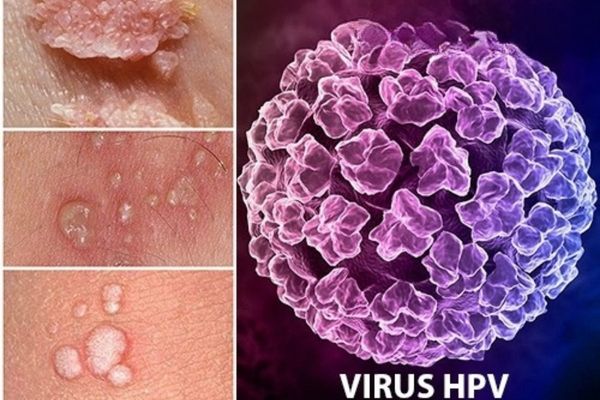 Sùi mào gà do virus HPV gây nên