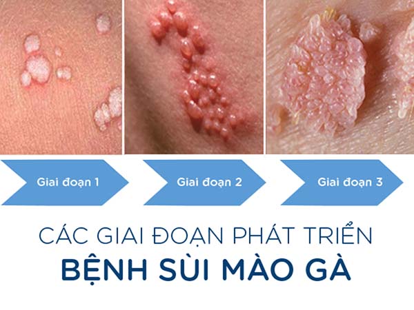 Dấu hiệu nhận biết sùi mào gà giai đoạn cuối và cách điều trị hiệu quả