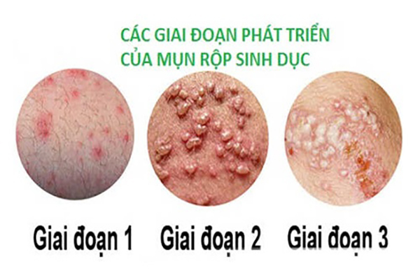 Mun-rop-sinh-duc