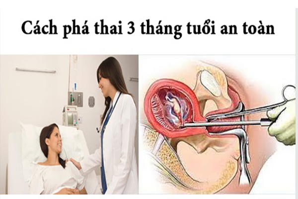 Phá thai 3 tháng bằng phương pháp nào an toàn và hiệu quả?