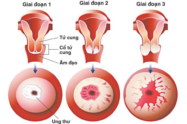 Dấu hiệu nhận biết bệnh lậu mãn tính và phương pháp điều trị hiệu quả