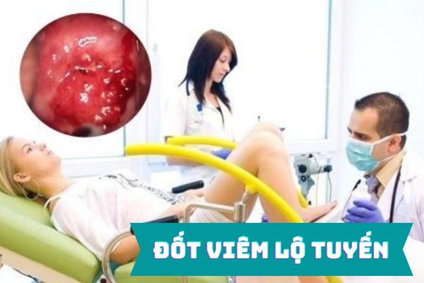 Đốt viêm lộ tuyến bằng phương pháp nào? Có đảm bảo an toàn không?