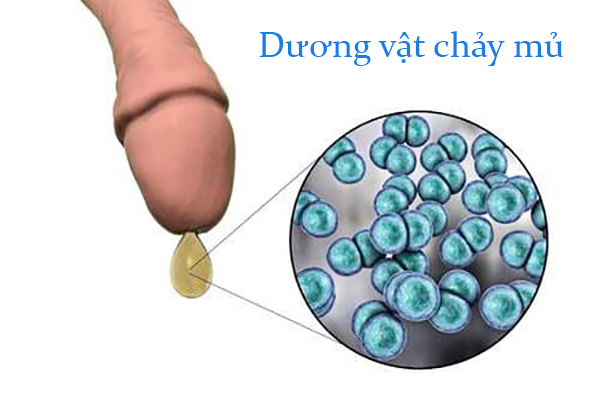 Đầu dương vật chảy mủ – Dấu hiệu cảnh báo bệnh lậu