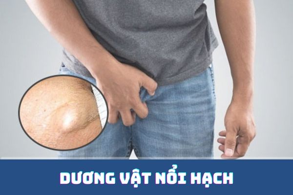 Dương vật nổi hạch – Dấu hiệu bệnh lý không thể xem thường