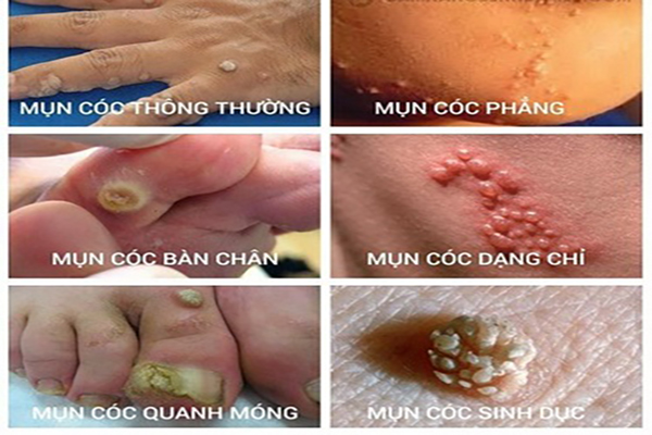 Cach-tri-mun-coc-hieu-qua-nhat-hien-nay