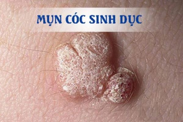 Mụn cóc sinh dục là bệnh lý thường gặp ở cả nam và nữ