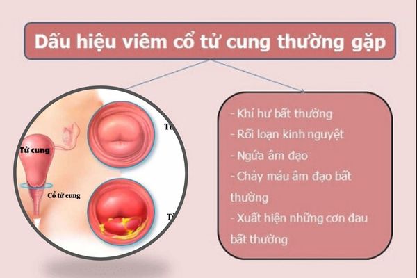 Triệu chứng nhận biết bệnh viêm cổ tử cung