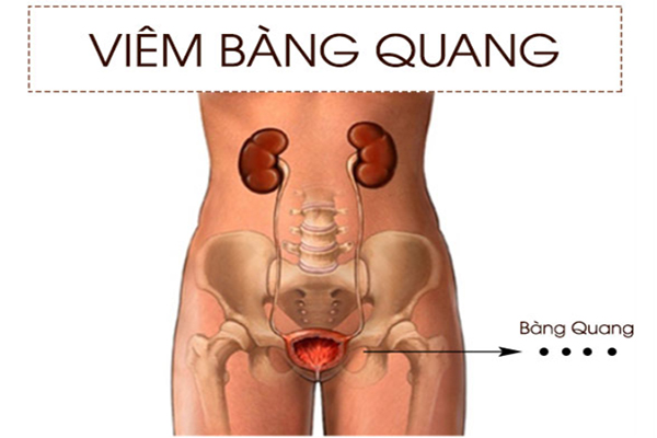 Viem-bang-quang