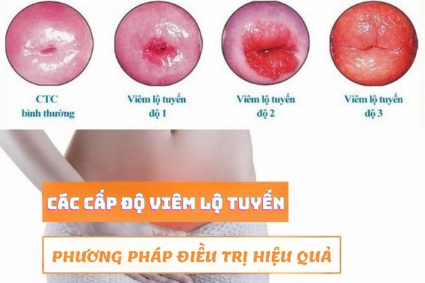 Các cấp độ viêm lộ tuyến và phương pháp điều trị hiệu quả