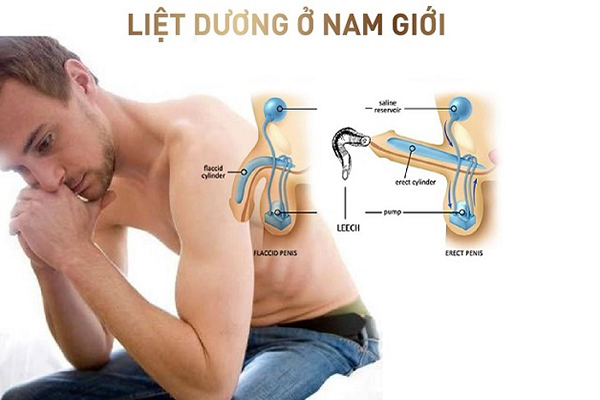 Liệt dương là gì? Làm thế nào để khắc phục?