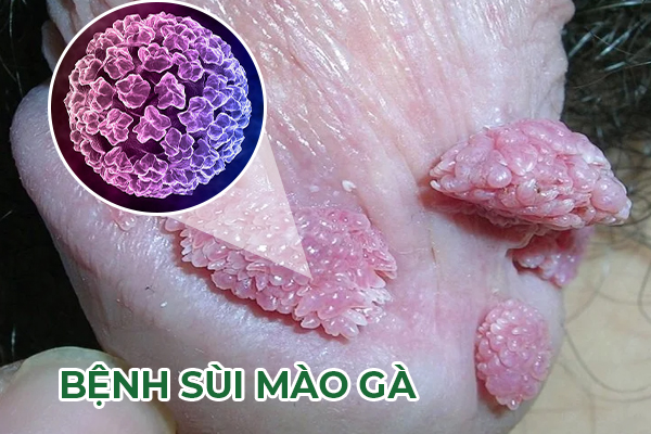 Tổng hợp một số thông tin hữu ích về bệnh sùi mào gà