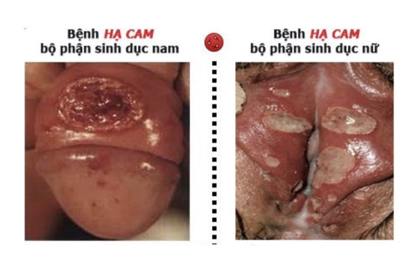 nhung-dieu-can-biet-ve-benh-ha-cam-mem