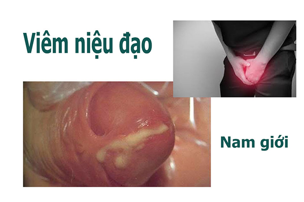 Viem_nieu_dao_nam_gioi