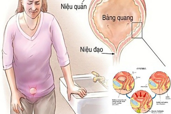 Viêm Niệu Đạo ở nữ: Nguyên nhân, dấu hiệu và cách khắc phục